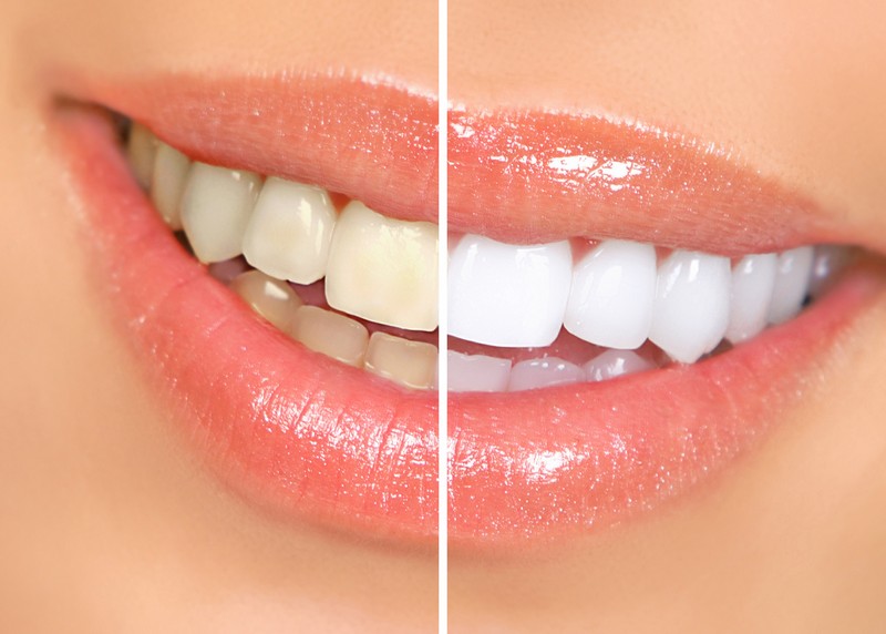 Teeth Whitening Braintree, MA 